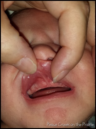 Lip Tie in one month old before clipping